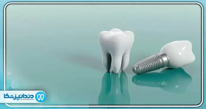 چه کسانی نمی توانند ایمپلنت دندان انجام دهند؟ - خبرگزاری آنلاین | اخبار ایران و جهان